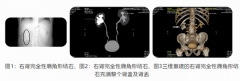 圣誕節(jié)前夕的“斬鹿角行動(dòng)”——記臨滄市中醫(yī)醫(yī)院外一科成功開(kāi)展